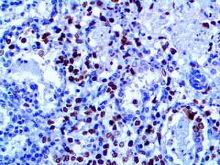 IHC of Herpes Simplex Virus on a FFPE Infected Tissue